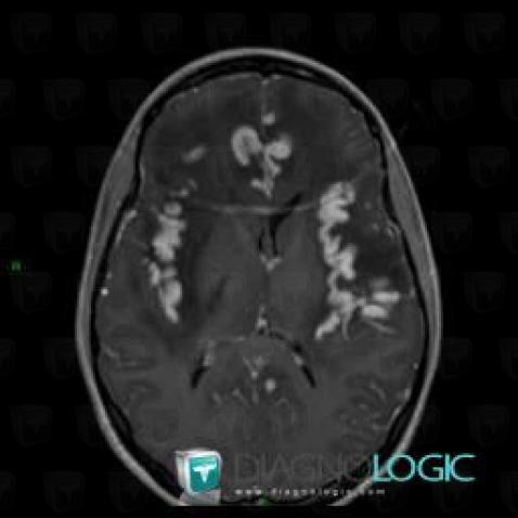 Herpes simplex encephalitis, Cortico subcortical region, Cerebral hemispheres, MRI