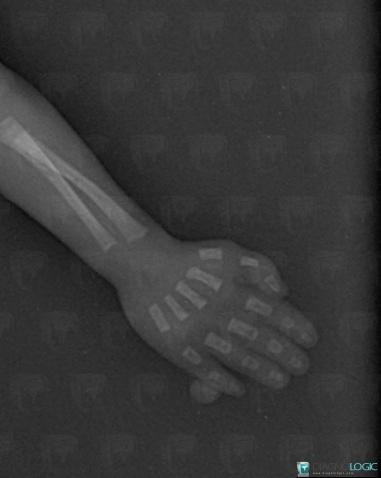 Hexadactyly, Phalanx / Sesamoid bones - Hand, X rays