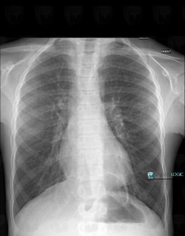 Hiatal hernia, Diaphragm, X rays