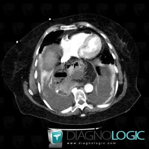 Hiatal hernia, Mediastinum, CT