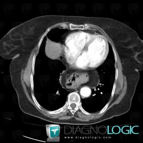 Hiatal hernia, Mediastinum, CT