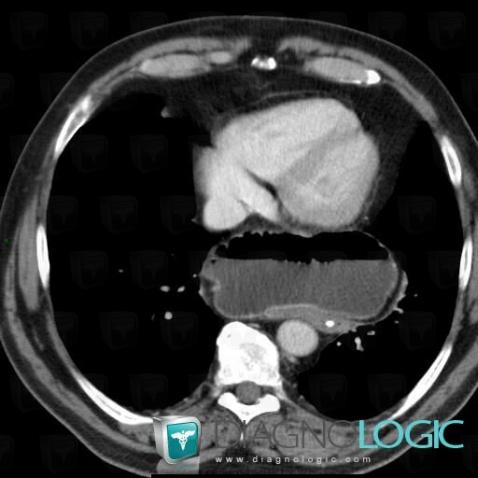 Hiatal hernia, Mediastinum, CT