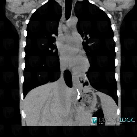 Hiatal hernia, Mediastinum, CT