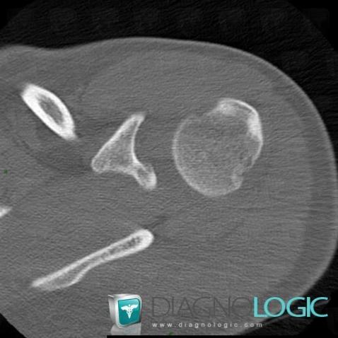 Hill-Sachs lesion, Humerus - Proximal part, CT