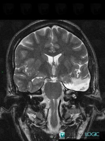 Hippocampal sclerosis, Cortico subcortical region, Cerebral hemispheres, MRI