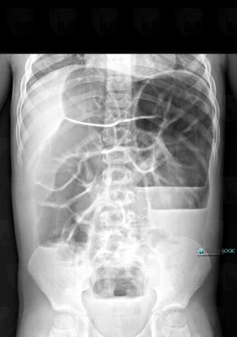 Hirschsprung disease, Rectum, X rays