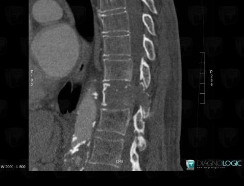 Histiocytofibrome malin, Corps vertébral / Disque, Scanner