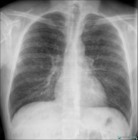 Histiocytose-cellules-Langerhans, Parenchyme pulmonaire, Radio