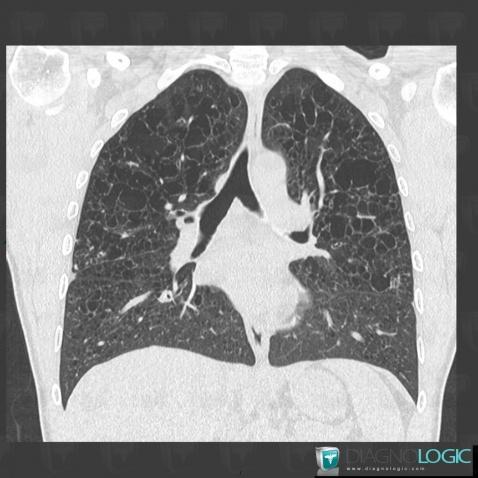 Histiocytose-cellules-Langerhans, Parenchyme pulmonaire, Scanner