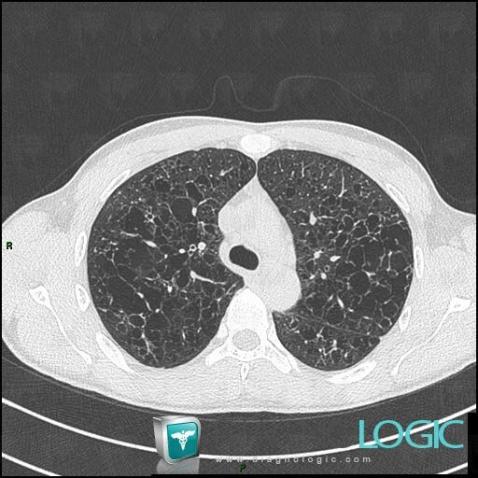 Histiocytose-cellules-Langerhans, Parenchyme pulmonaire, Scanner
