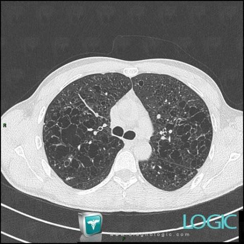 Histiocytose-cellules-Langerhans, Parenchyme pulmonaire, Scanner
