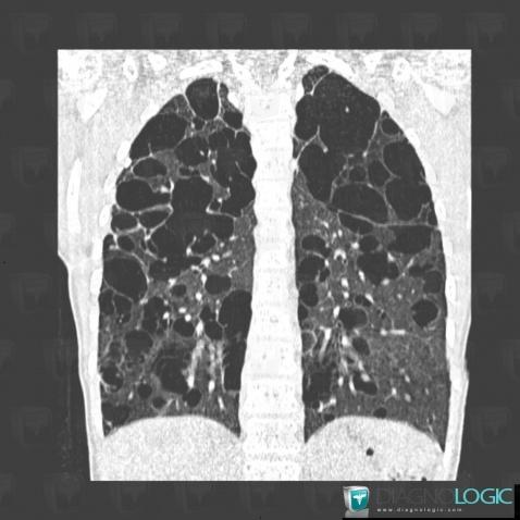 Histiocytose-cellules-Langerhans, Parenchyme pulmonaire, Scanner