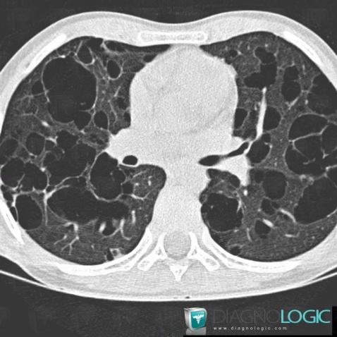 Histiocytose-cellules-Langerhans, Parenchyme pulmonaire, Scanner