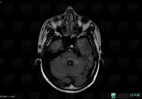 HIV encephalopathy, Brainstem, Posterior fossa, MRI