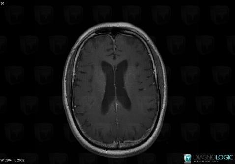 HIV encephalopathy, Cerebral hemispheres, MRI