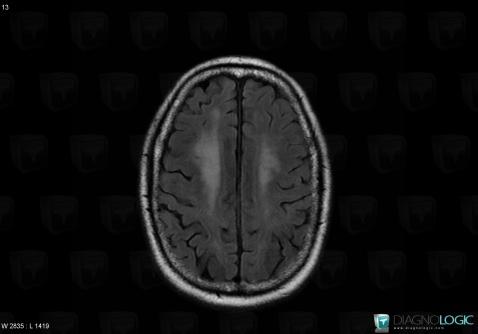 HIV encephalopathy, Cerebral hemispheres, MRI