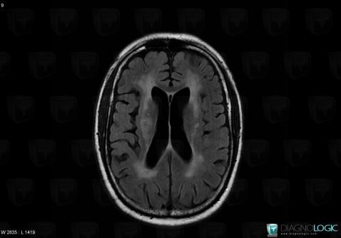 HIV encephalopathy, Cerebral hemispheres, Ventricles / Periventricular region, MRI