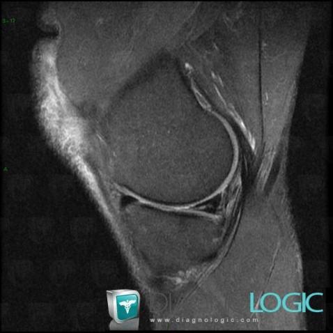 Horizontal-oblique meniscal tear, Meniscus, MRI