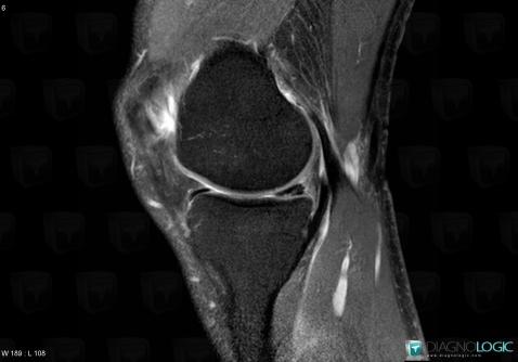 Horizontal-oblique meniscal tear, Meniscus, MRI