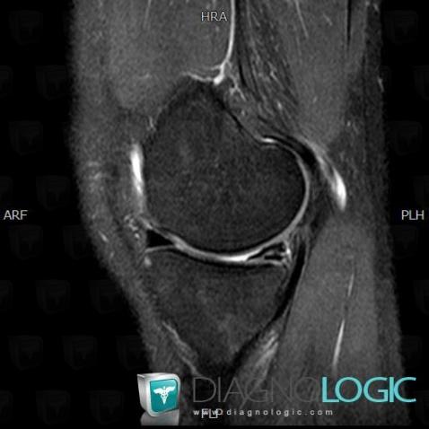 Horizontal-oblique meniscal tear, Meniscus, MRI