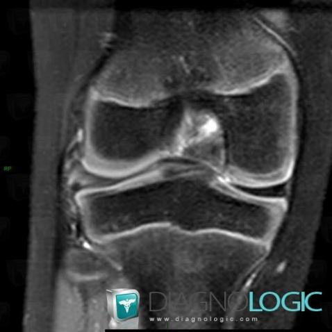 Horizontal-oblique meniscal tear, Meniscus, MRI