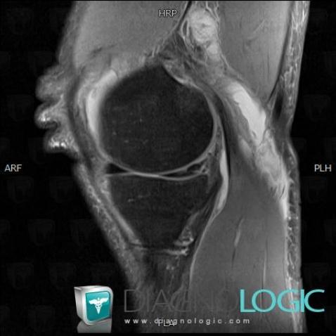 Horizontal-oblique meniscal tear, Meniscus, MRI