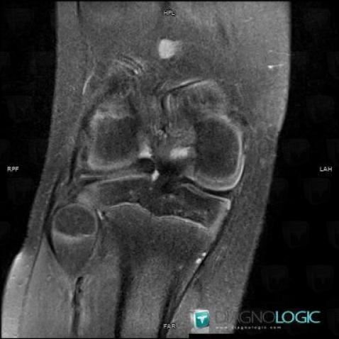 Horizontal-oblique meniscal tear, Meniscus, MRI