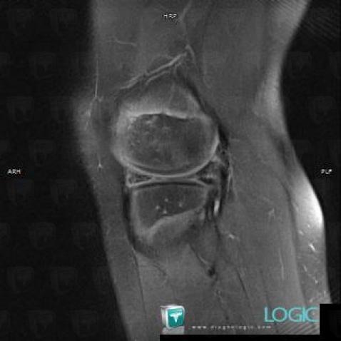 Horizontal-oblique meniscal tear, Meniscus, MRI
