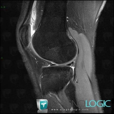 Radiology case : Anterior cruciate ligament rupture (MRI) - Diagnologic