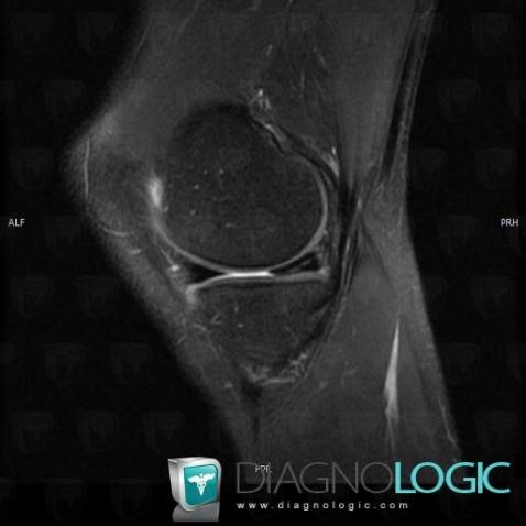 Radiology case : Meniscal flap tear (MRI) - Diagnologic