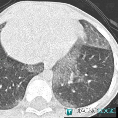 Hyaline membrane disease, Pulmonary parenchyma, CT