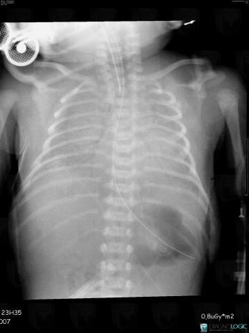 Hyaline membrane disease, Pulmonary parenchyma, X rays