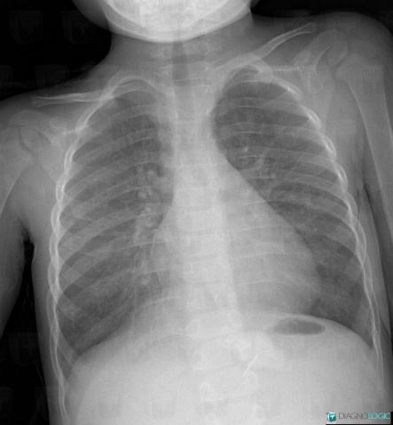 Hyaline membrane disease, Pulmonary parenchyma, X rays