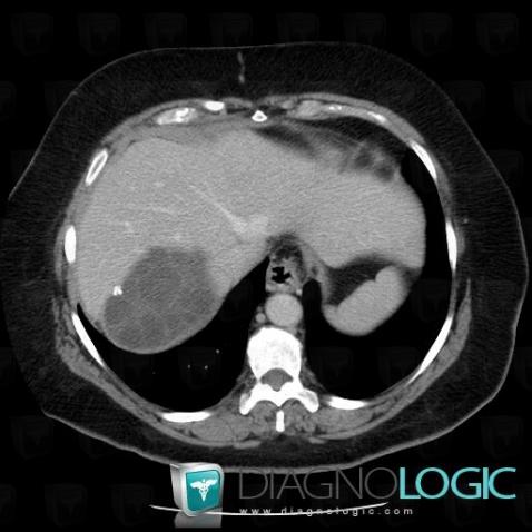 Hydatid disease, Liver, CT