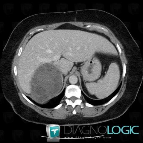 Hydatid disease, Liver, CT