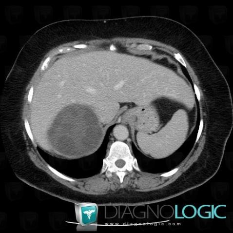 Hydatid disease, Liver, CT