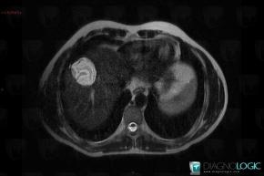 Hydatid disease, Liver, MRI