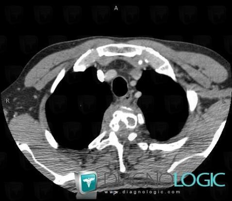 Hydatid disease, Mediastinum, CT