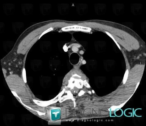 Hydatid disease, Mediastinum, CT