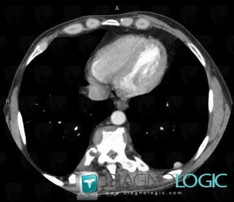 Hydatid disease, Pleura, CT