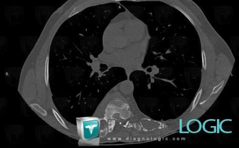 Hydatid disease, Ribs, CT