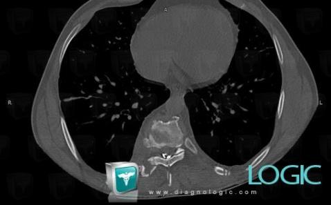 Hydatid disease, Vertebral body / Disk, CT