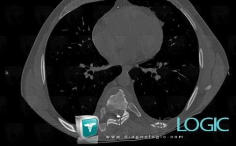 Hydatid disease, Vertebral body / Disk, CT