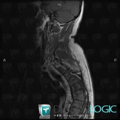 Hydatid disease, Vertebral body / Disk, MRI