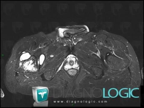 Hydatidose , Articulation coxo fémorale, Autres parties molles/nerfs - Bassin, IRM