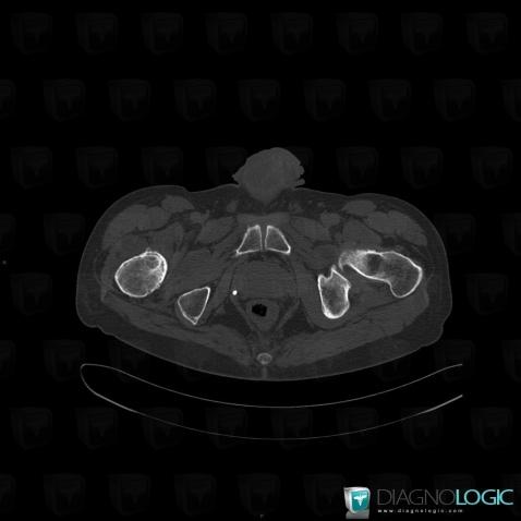 Hydatidose , Articulation coxo fémorale, Autres parties molles/nerfs - Bassin, Scanner