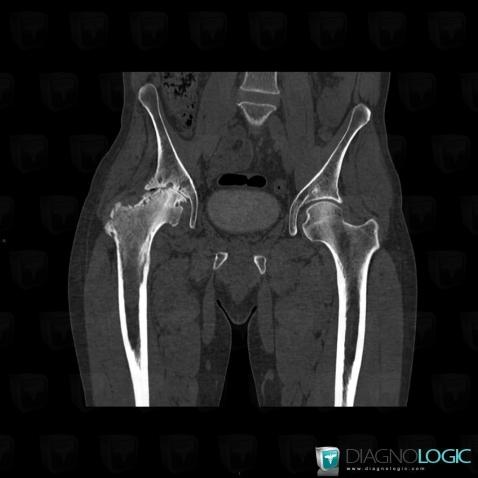 Hydatidose , Articulation coxo fémorale, Scanner