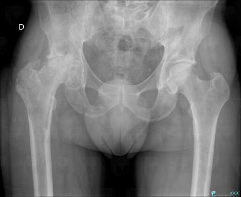 Hydatidose , Fémur -supérieur, Articulation coxo fémorale, Radio