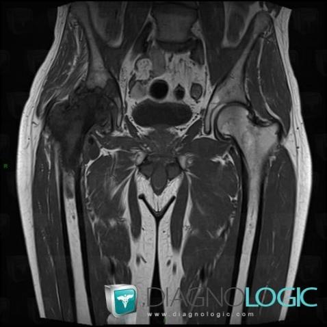 Hydatidose , Os iliaque, Fémur -supérieur, IRM