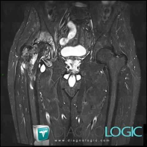 Hydatidose , Os iliaque, Fémur -supérieur, IRM